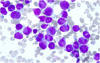 Case report: One case of acute myeloid leukemia M3 with atypical morphology
